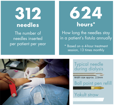 312 needles - The number of needles inserted per patient per year. 624 hours* -  How long the needles stay in a patient's fistula annually.